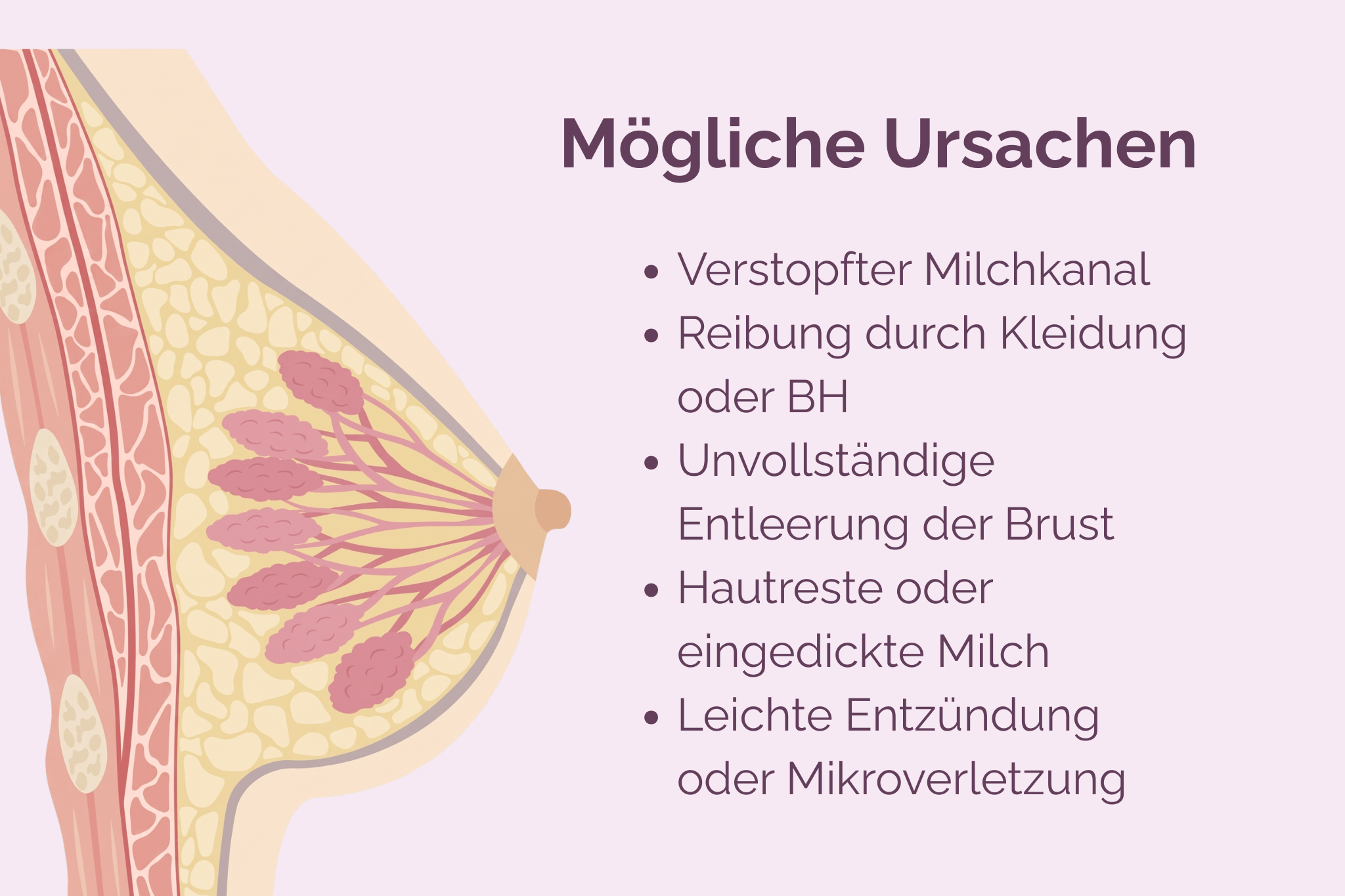 Illustration einer Brust im Querschnitt mit Milchgängen, daneben eine Liste möglicher Ursachen für Milchbläschen: verstopfter Milchkanal, Reibung durch Kleidung oder BH, unvollständige Entleerung der Brust, Hautreste oder eingedickte Milch sowie leichte Entzündung oder Mikroverletzung.